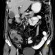 Appendicitis, gangrenous appendicitis, gangrene: CT - Computed tomography